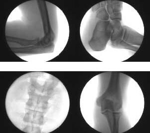 /c-arm-x-ray-system